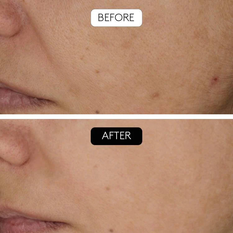 Serum antiedad + microneedling