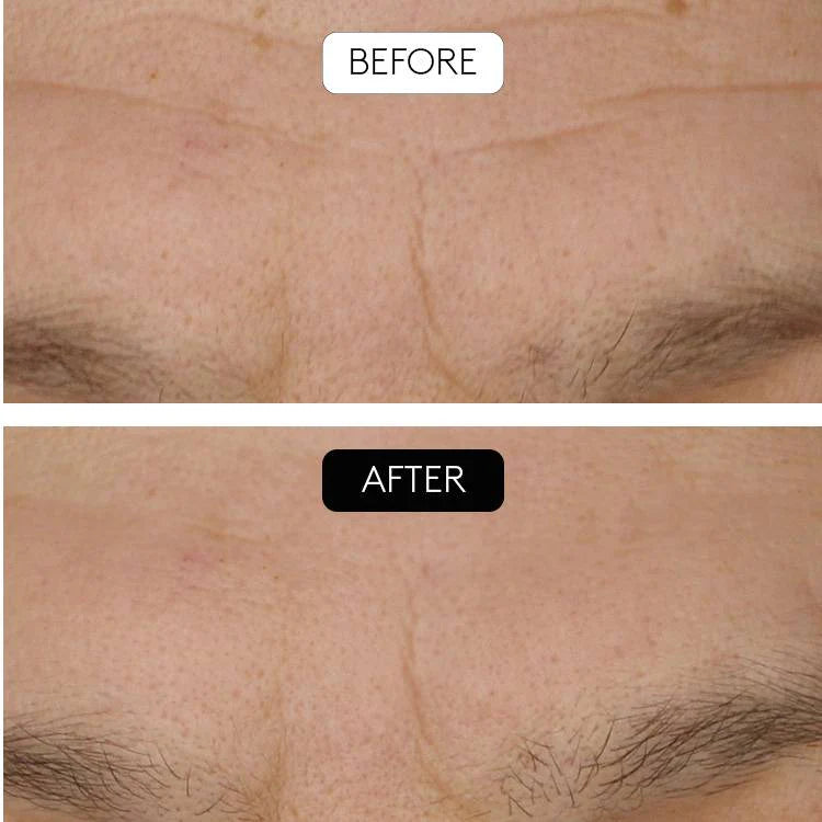 Serum antiedad + microneedling