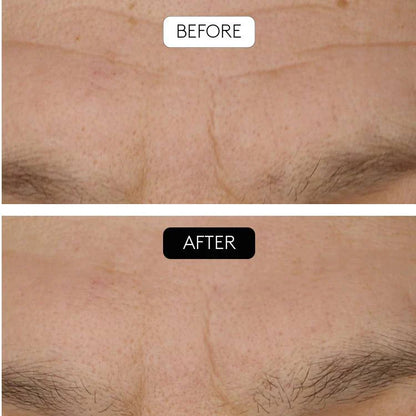 Serum antiedad + microneedling